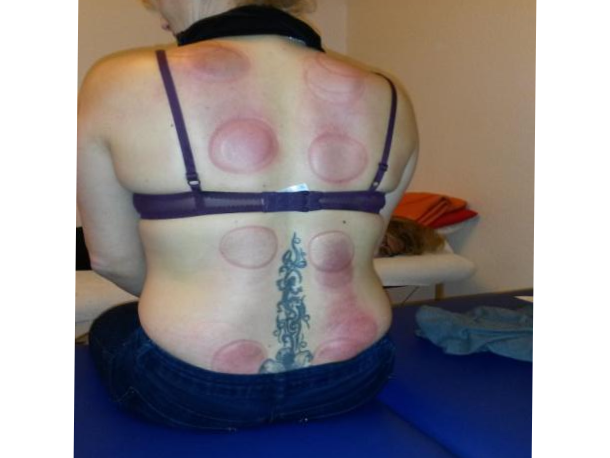 Schröpf-Therapie in der Heilpraktiker Praxis Münster von Iris Kreuzheck-Koch