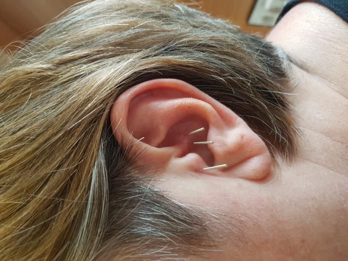 Ohr Akupunktur | Heilpraktiker Praxis Münster